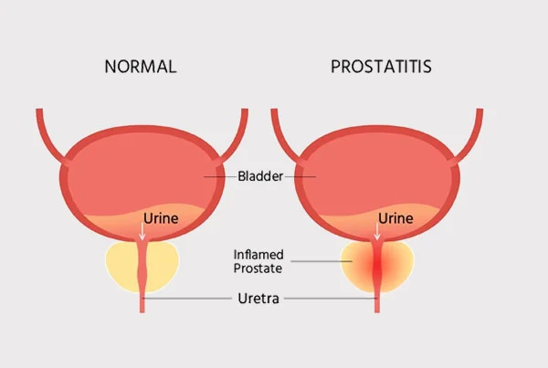 Robotic Radical Prostatectomy