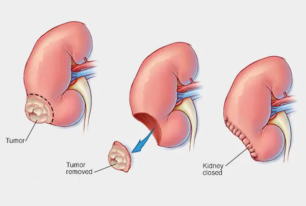 Robotic and Laparoscopic Radical or Partial Nephrectomy