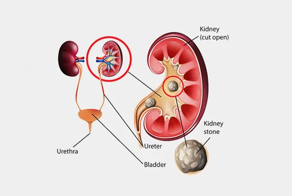 Kidney Stones Laser PCNL, RIRS, URS
