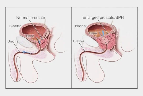 BPH Prostate Enlargement HOLEP, TURP, Urolift and REZUM