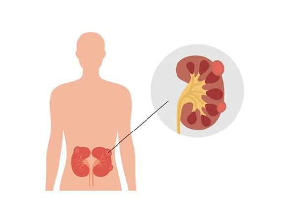 Partial or Total Cystectomy
